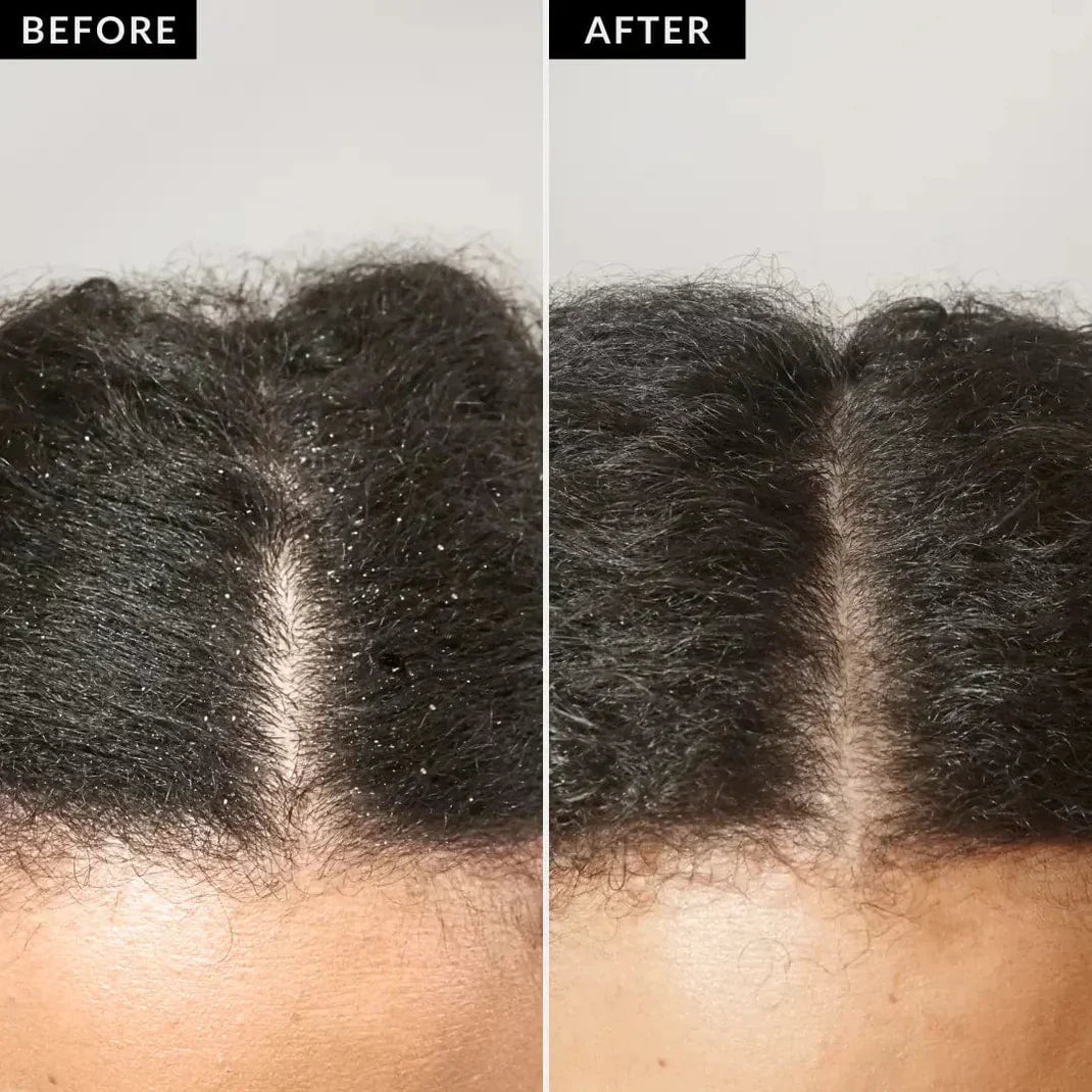 Anti-Dandruff Scalp Detox Comb