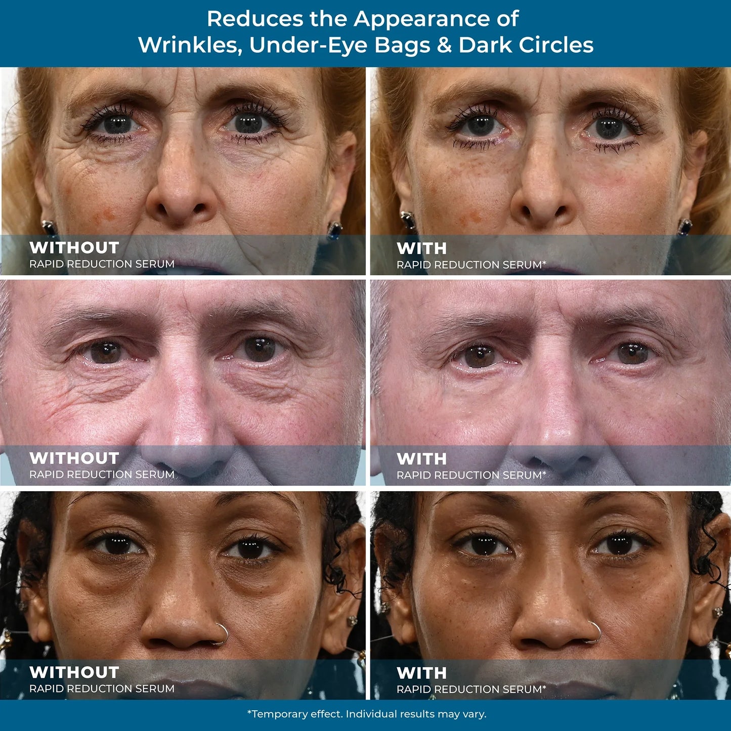 ZeroBags™ Under-Eye Serum